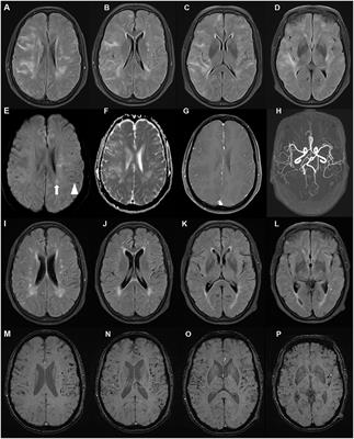 A Case of Cerebral Amyloid Angiopathy-Related Inflammation With the Rare Apolipoprotein ε2/ε2 Genotype